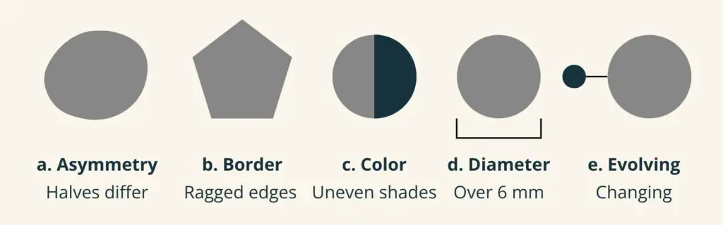 ABCDE guide for checking a mole: asymmetry, an uneven border, more than one color, a diameter larger than a pencil eraser, and any spot that is evolving or changing.